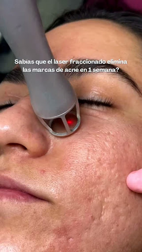 Tratamiento Láser CO2 - Aplicación