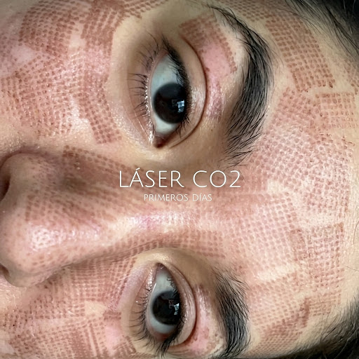 Tratamiento Láser CO2 - Clínica